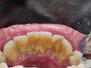 before-after photo teeth-cleaning