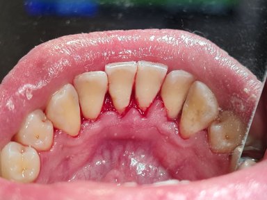 before-after photo teeth-cleaning