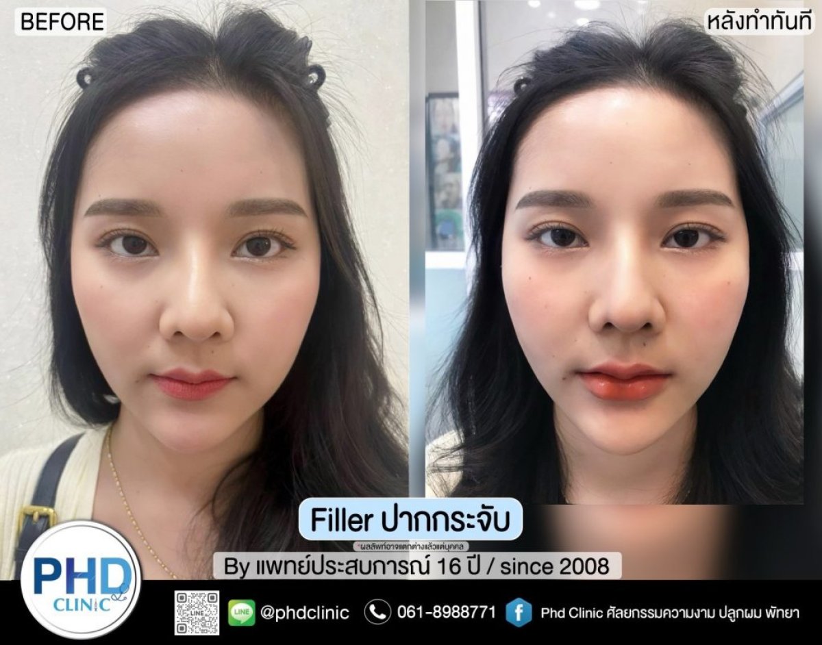 Resultados antes y después de relleno de labios en PHD Clinic – volumen y forma mejorados