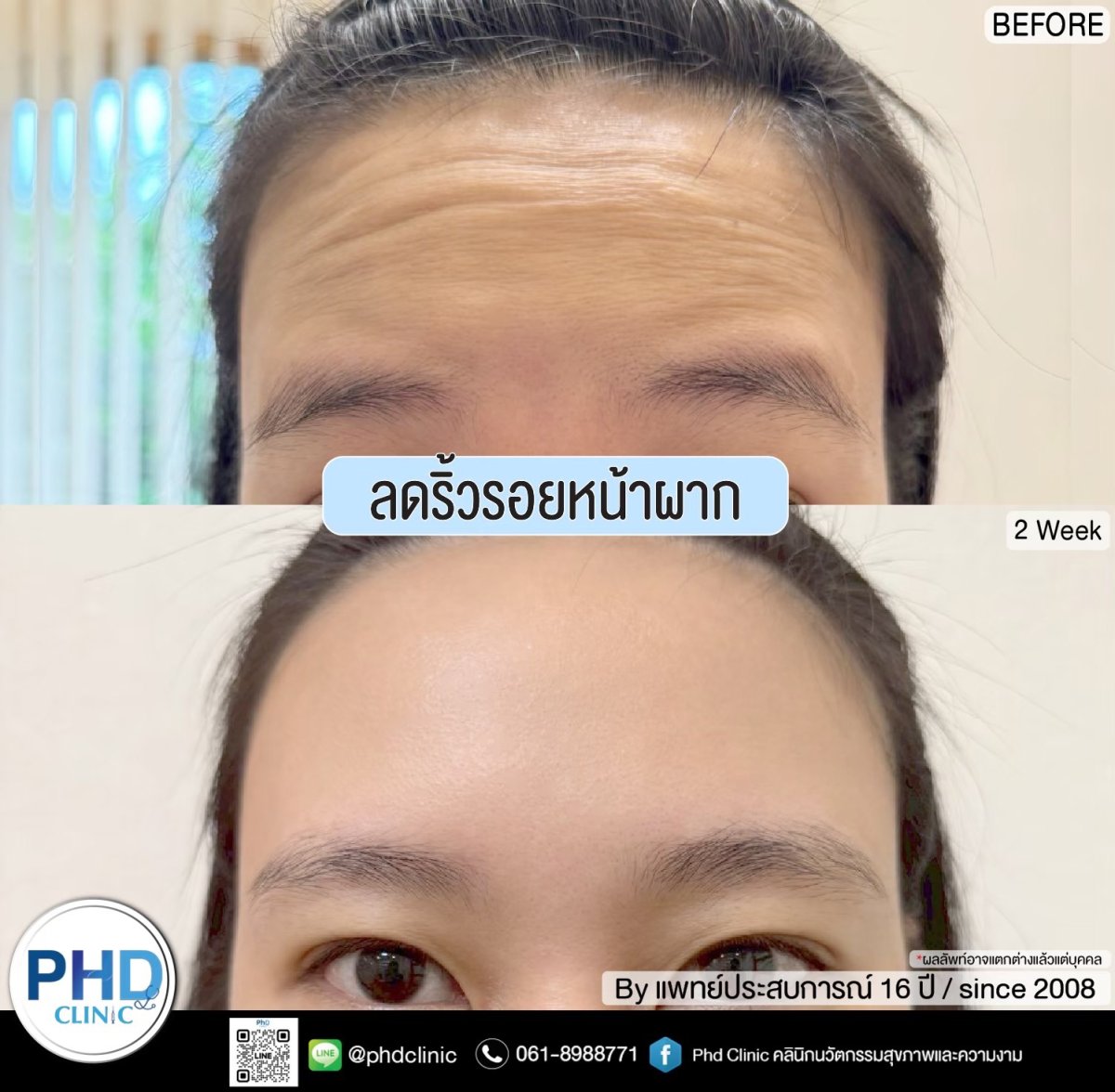 تقليل تجاعيد الجبهة بحقن مضادة للتجاعيد في PHD Clinic، النتيجة بعد أسبوعين