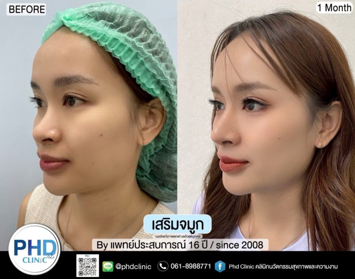نتائج تجميل الأنف قبل وبعد في عيادة PHD، إعادة تشكيل الأنف بعد شهر واحد