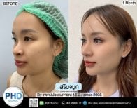 نتائج تجميل الأنف قبل وبعد في عيادة PHD، إعادة تشكيل الأنف بعد شهر واحد