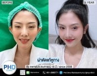 نتائج تجميل الأذن قبل وبعد في PHD Clinic – إعادة تشكيل الأذن بمظهر طبيعي