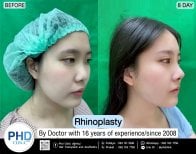 نتيجة عملية تجميل الأنف قبل وبعد في PHD Clinic، تغيير واضح لشكل الأنف بعد 8 أيام