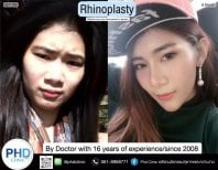 نتائج عملية تجميل الأنف قبل وبعد في عيادة PHD، إعادة تشكيل الأنف بمظهر طبيعي