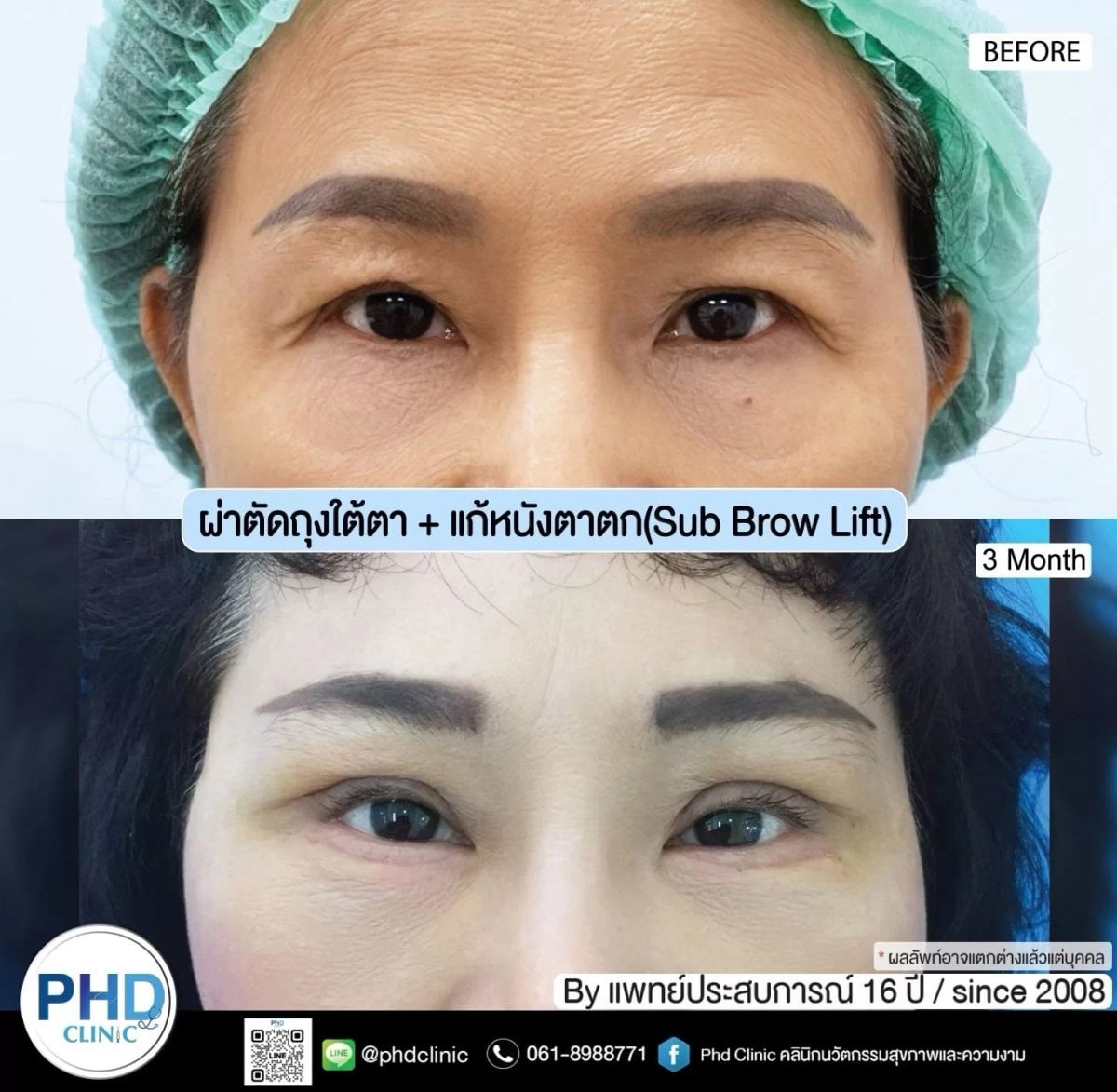 نتائج رفع الحاجب في PHD Clinic – تحسن مظهر الجفون بعد 3 أشهر