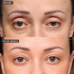 Résultats avant/après chirurgie des paupières chez VG Plastic Surgery, 2 semaines après