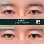 Résultats avant et après chirurgie des paupières chez SAERO Plastic Surgery, 1 mois