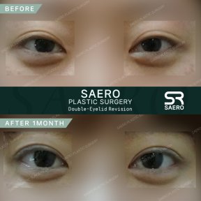 Résultats avant/après révision des paupières doubles chez SAERO Plastic Surgery, 1 mois