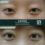 Résultats avant/après révision des paupières doubles chez SAERO Plastic Surgery, 1 mois