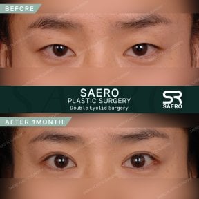 Résultats avant et après chirurgie des paupières chez SAERO Plastic Surgery, 1 mois