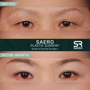 Résultats avant et après chirurgie des paupières chez SAERO Plastic Surgery, 1 mois