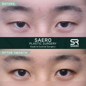 Résultats avant et après chirurgie des paupières doubles chez SAERO Plastic Surgery, 1 mois