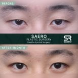 Résultats avant et après chirurgie des paupières doubles chez SAERO Plastic Surgery, 1 mois