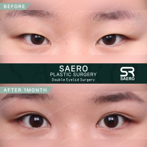 Résultats avant/après chirurgie des paupières chez SAERO Plastic Surgery, 1 mois