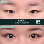 Résultats avant/après chirurgie des paupières chez SAERO Plastic Surgery, 1 mois