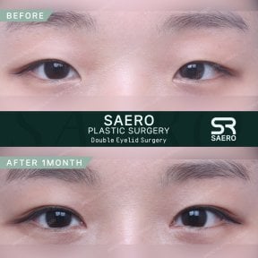 Résultats avant/après chirurgie des paupières doubles chez SAERO Plastic Surgery, 1 mois
