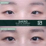 Résultats avant/après chirurgie des paupières doubles chez SAERO Plastic Surgery, 1 mois
