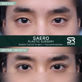 Résultats avant et après chirurgie des paupières et épicanthoplastie chez SAERO Plastic Surgery