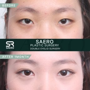 Résultats avant/après chirurgie des paupières doubles chez SAERO Plastic Surgery, 1 mois