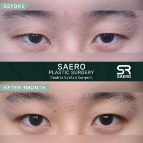 Résultats avant et après chirurgie des paupières doubles chez SAERO Plastic Surgery, 1 mois