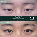 Résultats avant et après chirurgie des paupières doubles chez SAERO Plastic Surgery, 1 mois