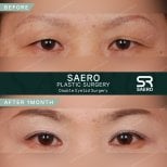 Résultats avant et après chirurgie des paupières doubles chez SAERO Plastic Surgery, 1 mois