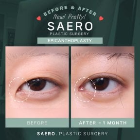 Résultats avant et après épicanthoplastie chez SAERO Plastic Surgery, amélioration de la forme des yeux