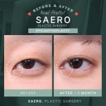 Résultats avant et après épicanthoplastie chez SAERO Plastic Surgery, amélioration de la forme des yeux