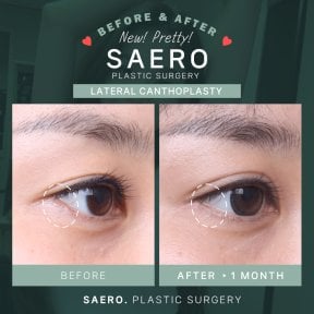 Résultats avant/après canthoplastie latérale chez SAERO Plastic Surgery, amélioration des yeux