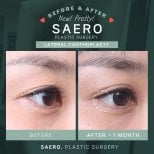 Résultats avant/après canthoplastie latérale chez SAERO Plastic Surgery, amélioration des yeux