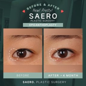Résultats avant et après épicanthoplastie chez SAERO Plastic Surgery, amélioration des yeux