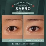 Résultats avant et après épicanthoplastie chez SAERO Plastic Surgery, amélioration des yeux