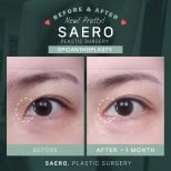 Résultats avant et après épicanthoplastie chez SAERO Plastic Surgery, amélioration de la forme des yeux