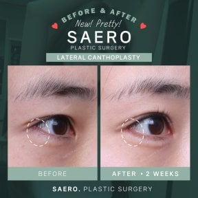 Résultats avant/après canthoplastie latérale chez SAERO Plastic Surgery, amélioration des yeux