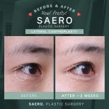 Résultats avant/après canthoplastie latérale chez SAERO Plastic Surgery, amélioration des yeux