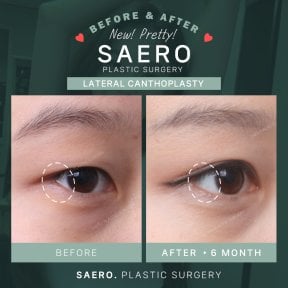 Résultats avant/après canthoplastie latérale chez SAERO Plastic Surgery, amélioration yeux