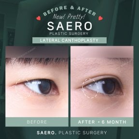 Résultats avant et après canthoplastie latérale chez SAERO Plastic Surgery, amélioration yeux