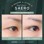 Résultats avant/après canthoplastie latérale chez SAERO Plastic Surgery, amélioration des yeux