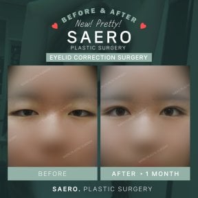 Résultats avant et après blépharoplastie inférieure chez SAERO Plastic Surgery, contour des yeux amélioré