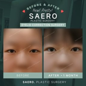 Résultats avant/après blépharoplastie inférieure chez SAERO Plastic Surgery, 1 mois