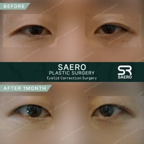 Résultat de blépharoplastie des paupières inférieures avant/après 1 mois chez SAERO