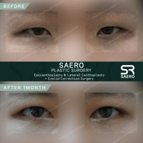 Résultats avant/après blépharoplastie inférieure chez SAERO Plastic Surgery, 1 mois post-op