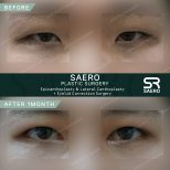 Résultats avant/après chirurgie des paupières supérieures chez SAERO Plastic Surgery, 1 mois