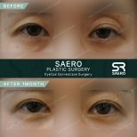Résultats avant et après chirurgie des paupières supérieures chez SAERO Plastic Surgery, 1 mois