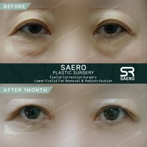 Résultats avant et après chirurgie des paupières supérieures chez SAERO Plastic Surgery, rajeunissement