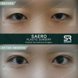 Résultats de blépharoplastie supérieure avant/après chez SAERO Plastic Surgery, 1 mois