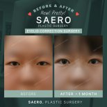 Résultats avant/après chirurgie des paupières supérieures chez SAERO Plastic Surgery, 1 mois