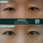 Résultats avant/après chirurgie des paupières supérieures chez SAERO Plastic Surgery, 1 mois