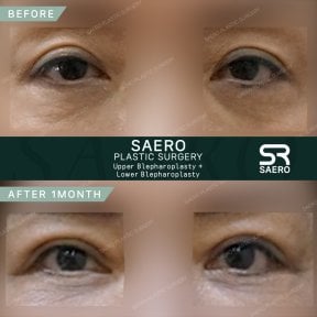 Résultats avant et après chirurgie des paupières supérieures et inférieures chez SAERO